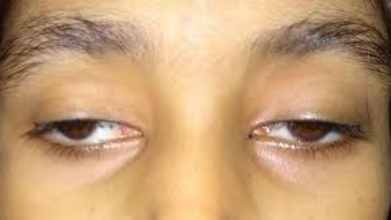 Global Ophthalmoplegia Market: Size, Trends, and Opportunities
