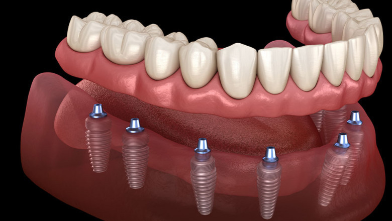 How Marietta Dental Implants Can Transform Your Smile—and Your Life