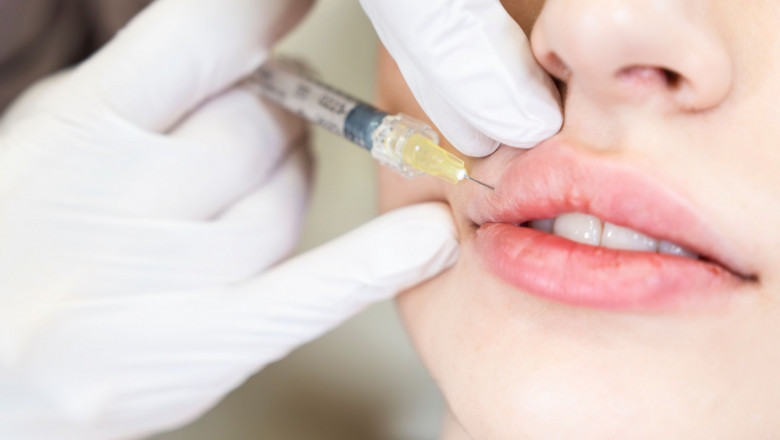 Lip Filler Market Forecast Shows Growth from Technological Advancements and Emerging Beauty Trends