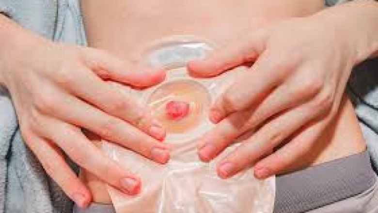 OstomyStoma Care Market Developments Focus on Personalization Technology and Patient Centric Solutions