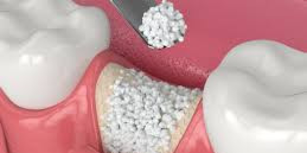 Dental Bone Graft Substitute Market Analysis: Size, Share, and Emerging Trends