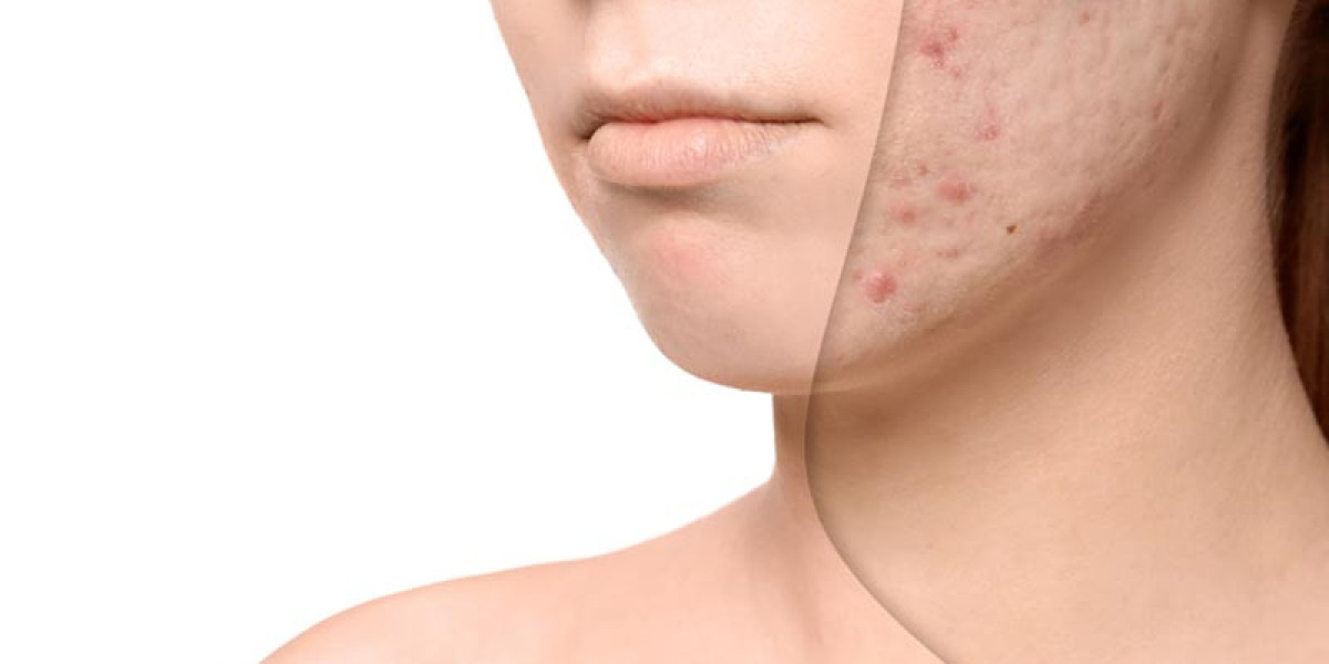 Navigating Acne Scar Treatments: Expectations in Singapore