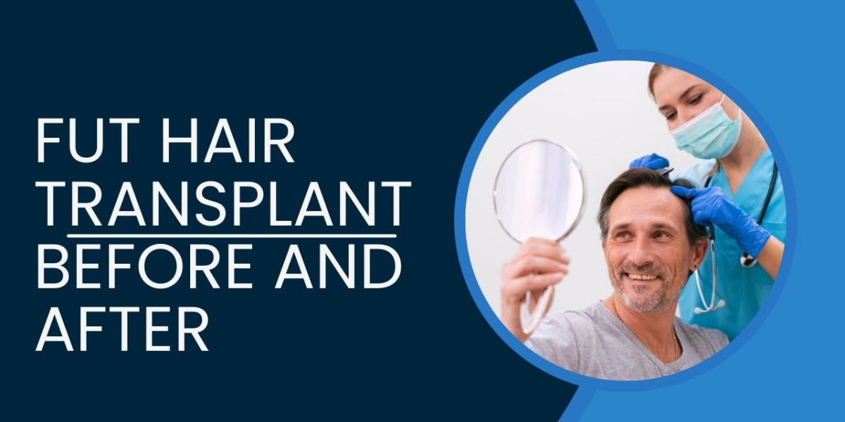 Unveiling the Top 10 Facts About FUT Hair Transplant Before and After