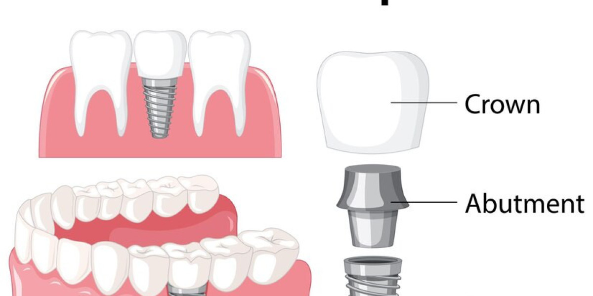 Understanding Dental Implant Healing Abutments: A Guide to Ritter Implants