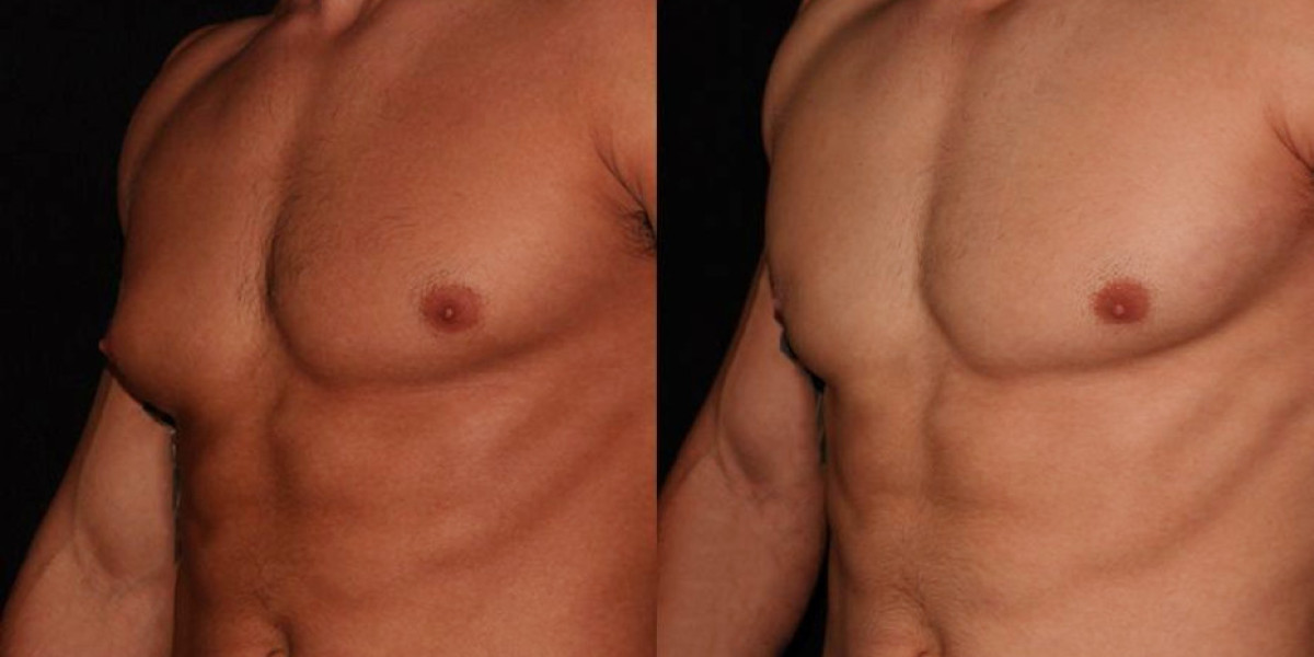 Gynecomastia Surgery and Maintaining a Healthy Weight: Strategies for Long-Term Results