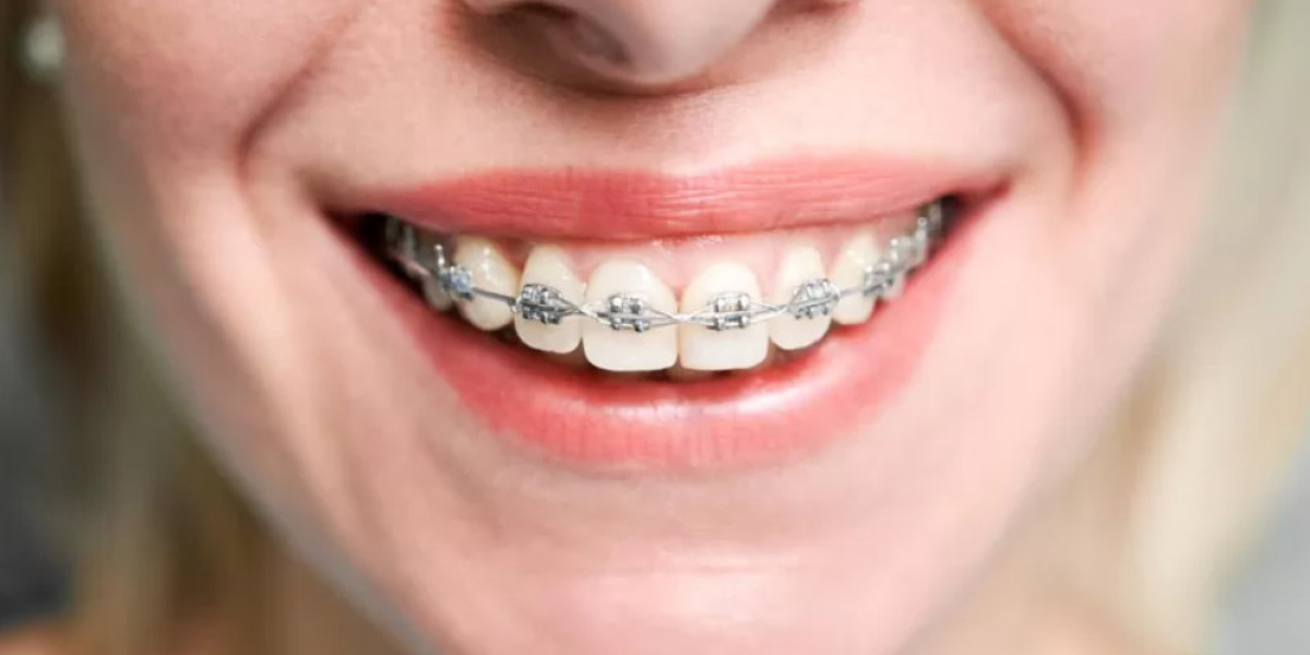 Discover Dental Braces at Excellency Medical Center in Abu Dhabi to Achieve Your Dream Smile