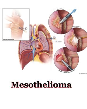 TOP 5 Best Mesothelioma Lawyer Directory | Penny Saver Info