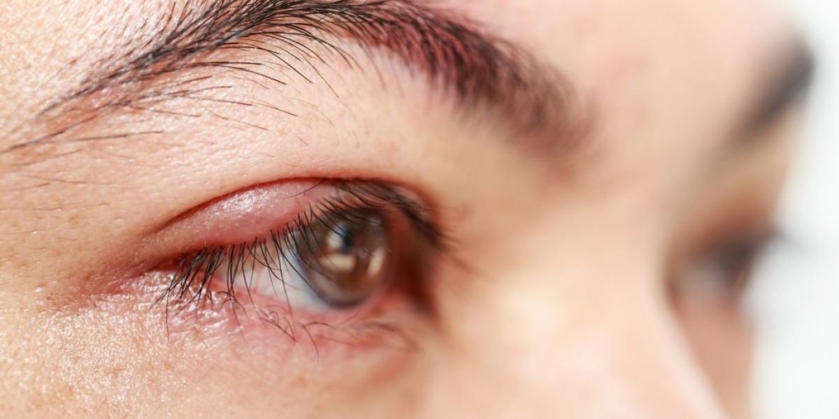 Blepharitis Treatment: Managing the Inflammation of Eyelids