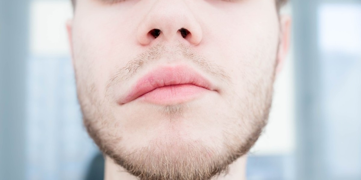 Angioedema Treatment: Understanding Options for Managing Symptoms