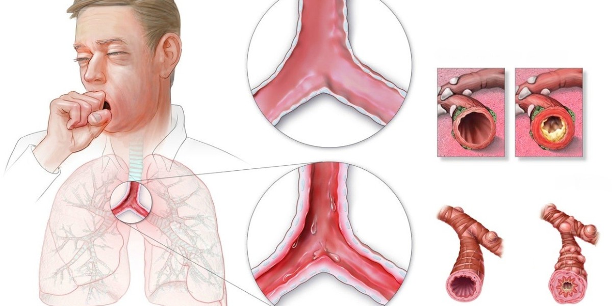 Global Bronchitis Treatment Market is estimated to Witness High Growth Owing to Technological Advancements in Diagnosis