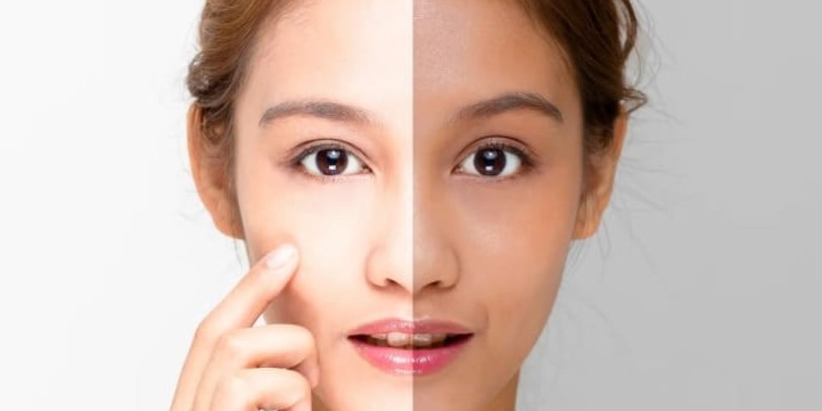 Singapore's Premier Face Whitening Laser Clinic for Radiant Results