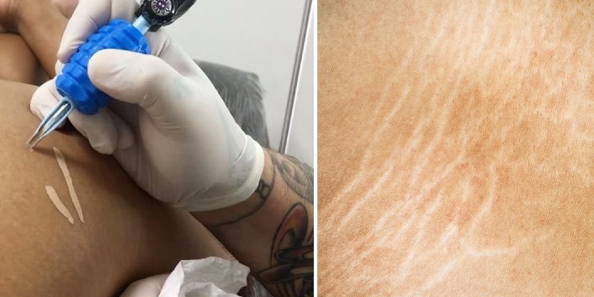 Tattoo Removal And Tattoo Over Stretch Marks