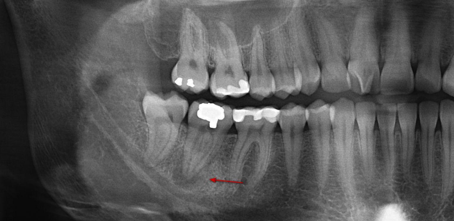 Root Canal Therapy in Fort Saskatchewan, Alberta