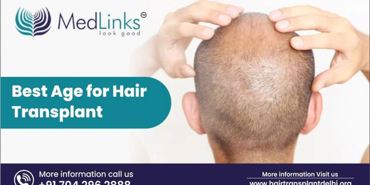 Hair Transplant in Delhi: A Trusted Solution for Hair Loss