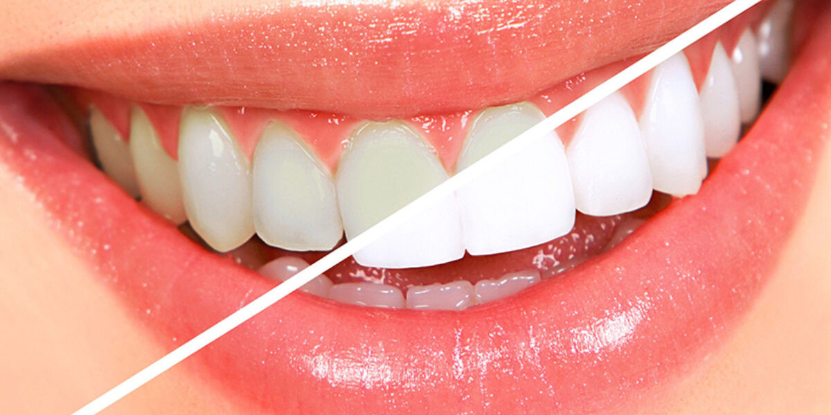 Is This the Best Laser Teeth Whitening in Dubai?