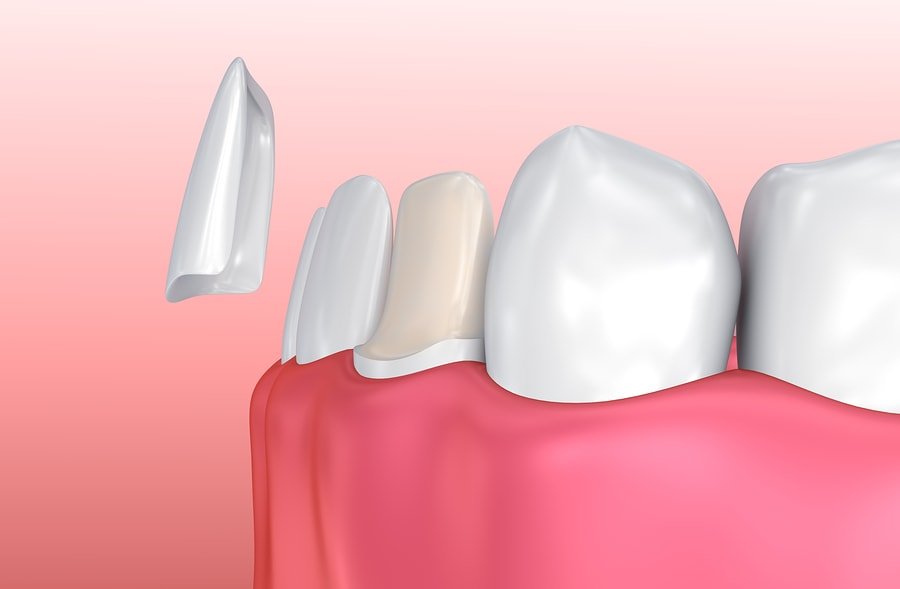 Dental Veneers Abu Dhabi | Dental Veneers Treatment Abu Dhabi