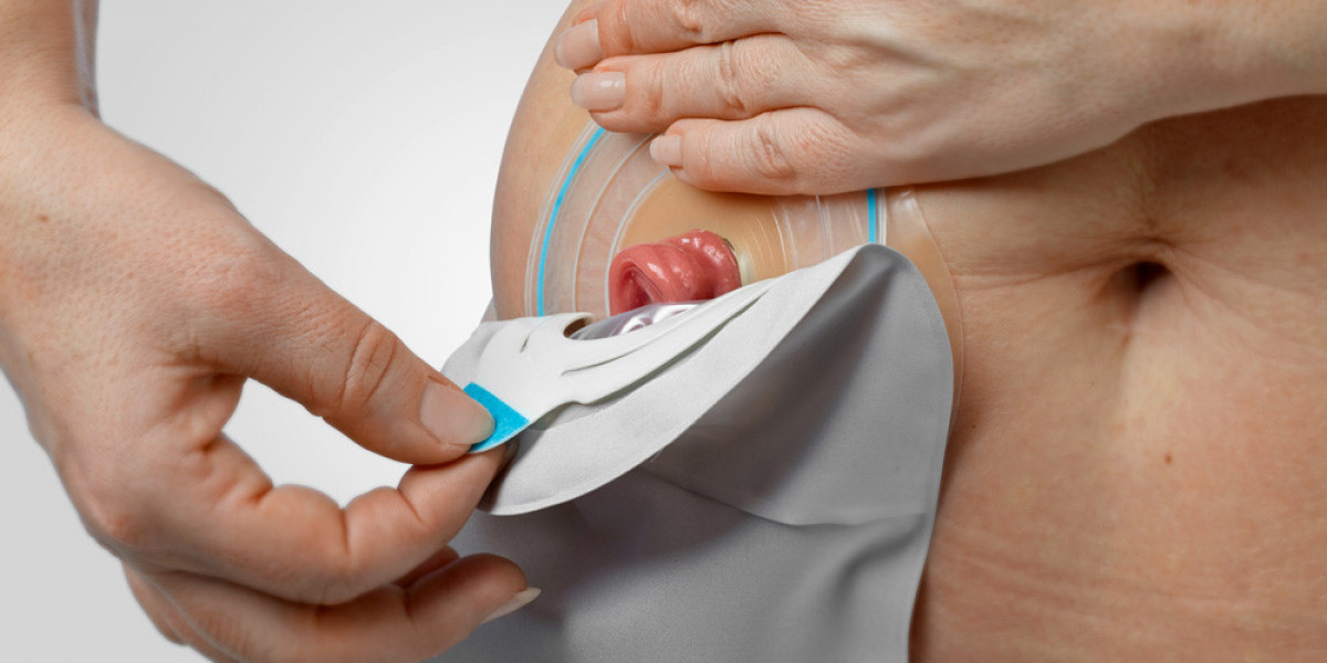 Ostomy Devices Market: Trends, Innovations, and Market Insights