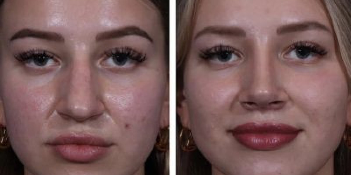 Bulbous Nose Job Before and After