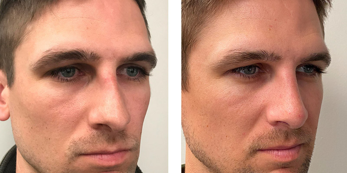 Best men's nose job: Transformations and Trends in Male Nose Jobs