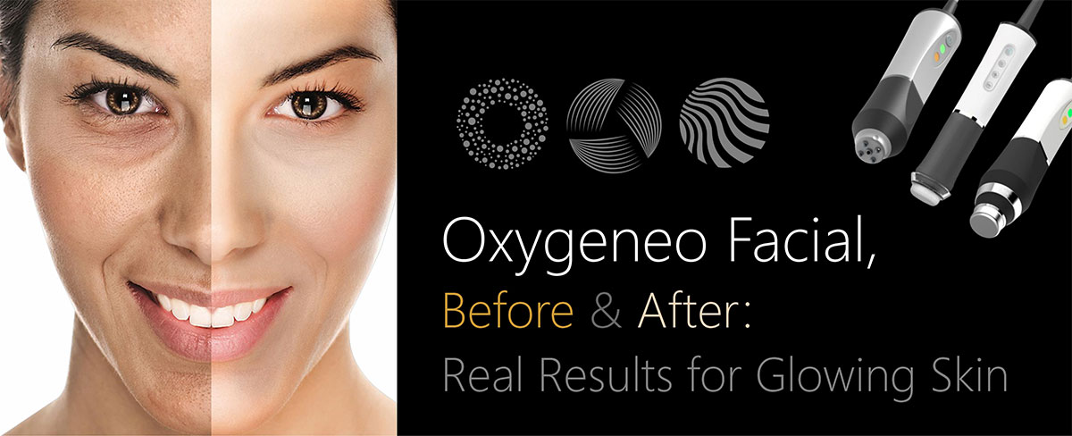 Oxygeneo Facial, Before and After: Real Results for Glowing Skin