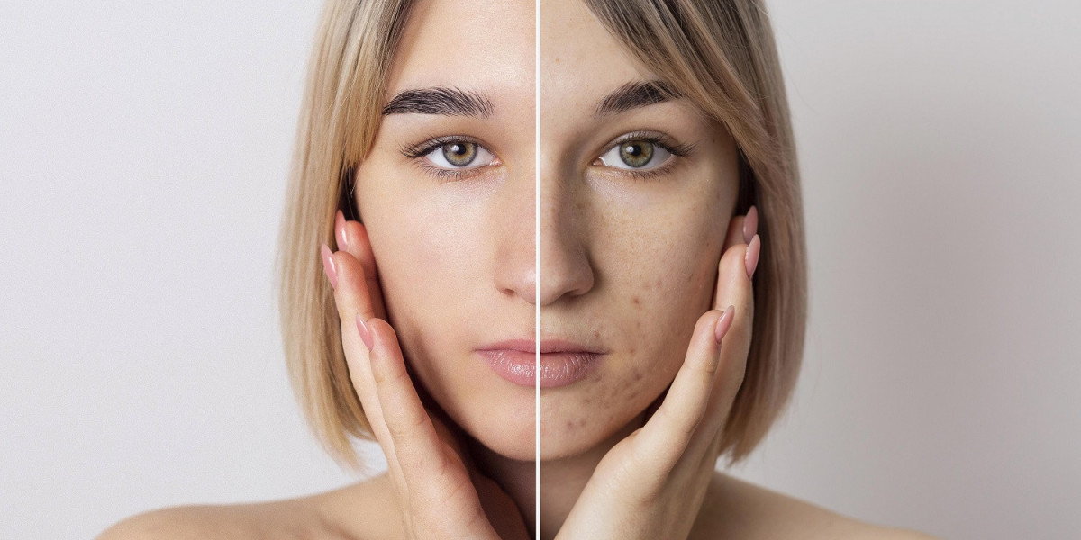 Clear Skin with Skin Renew’s Pigmentation Treatments in Auckland