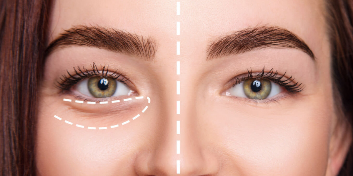 Exactly how Extensive Complete Beneath Eyesight Injectables Previous? What You Should Learn