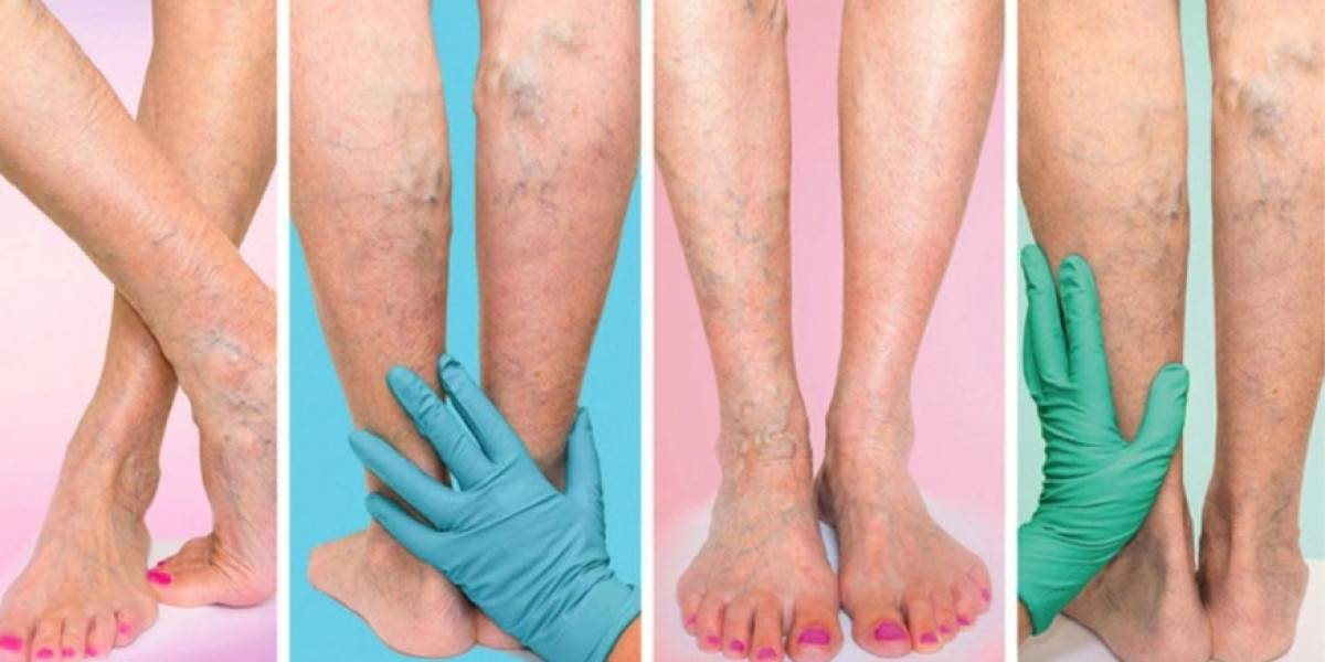 Can Cold Water Help with Varicose Veins? Exploring the Benefits