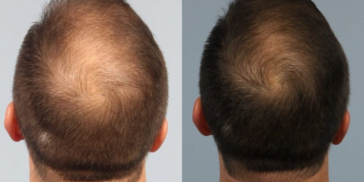 Hair Restoration Market Seeing Significant Advancements with Stem Cells, PRP, Robotics, and Hair Cloning Techniques