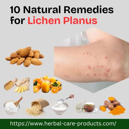 10 Natural Remedies for Lichen Planus - Herbal Care Products - Blog