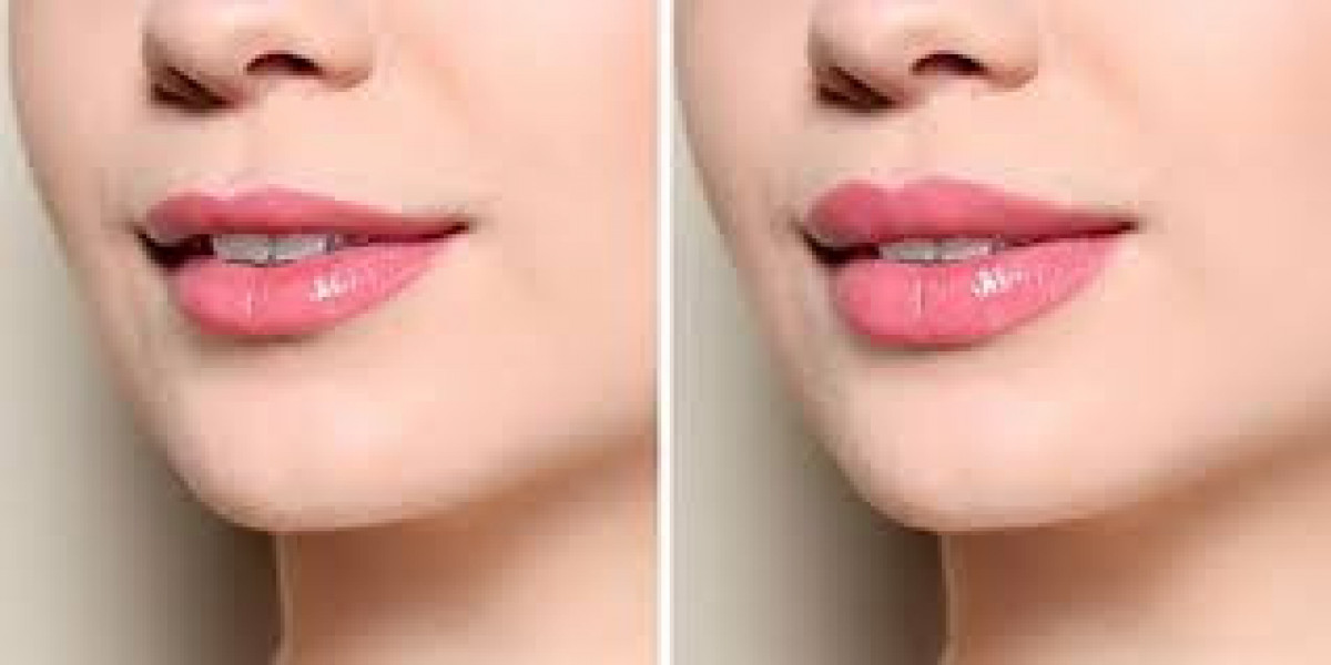 Lip Fillers in Chicago: Improving Your Normal Excellence