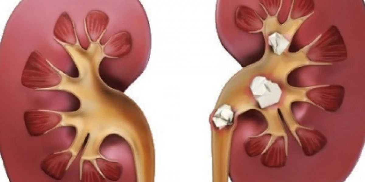 Understanding Ayurvedic Treatment For Kidney Stone: A Natural Path to Relief