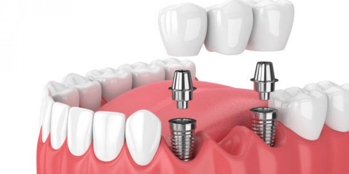 Dental Implants Perth: A Permanent Solution for Missing Teeth