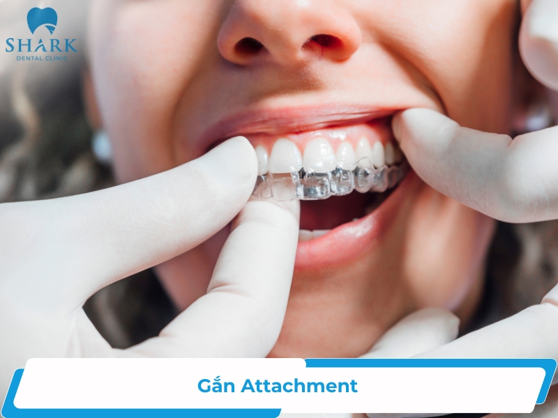 Gắn Attachment niềng răng trong suốt là gì? Có đau không?