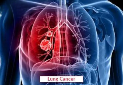 Lung Cancer Treatment In India | Types, Causes And Procedures