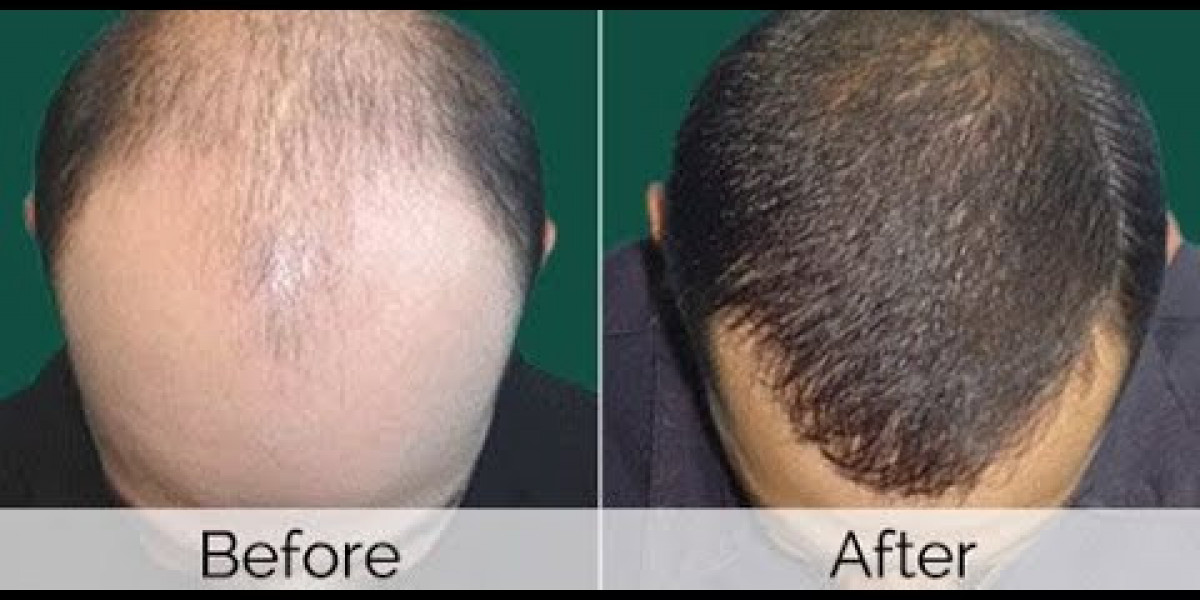أفضل مراكز زراعة الشعر في دبي: دليلك لاختيار العيادة المثالية
