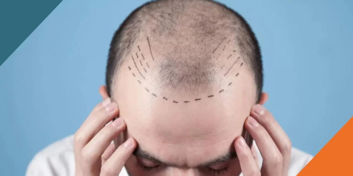 The Convergence of Beauty and Tech: Reinventing Hair Transplant Healing